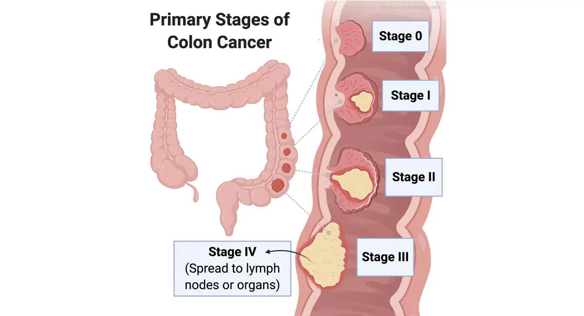 Colorectal Cancer Screening in Chandigarh